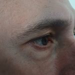 Glaucoma