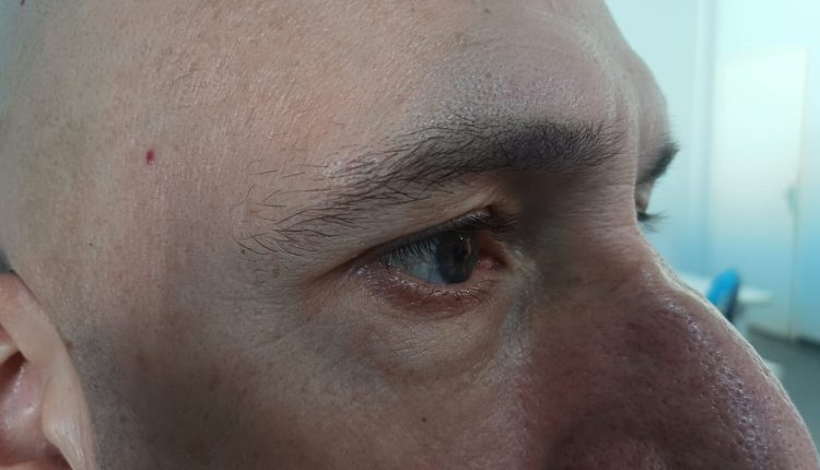 Glaucoma